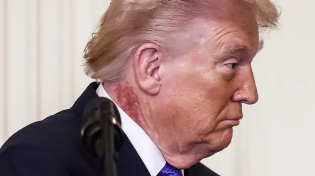 Health Worries Rise as New Neck Rash Appears on Donald Trump