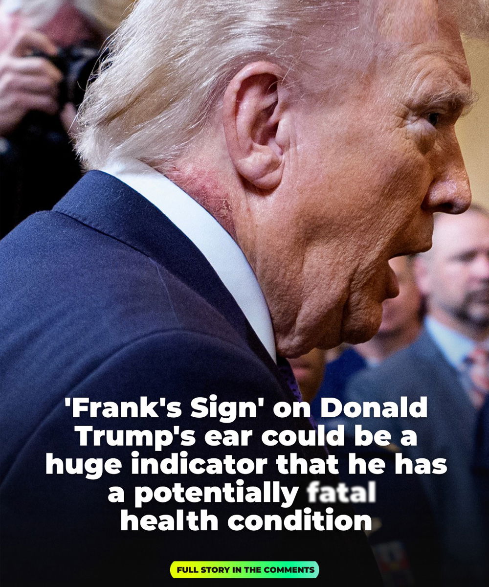 Is 'Frank's Sign' on Trump's Ear a Major Health Warning Sign?