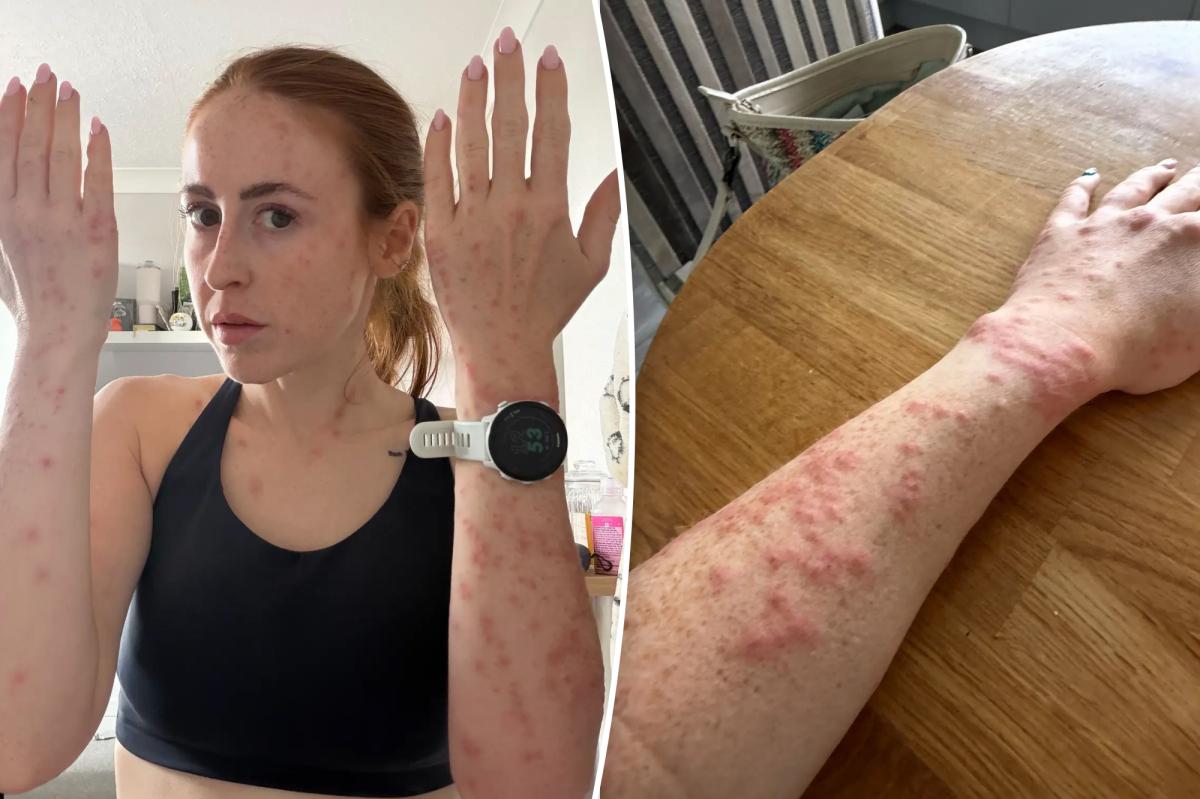 Traveler's Nightmare: Bedbug Attack Leaves Her Scarred for Life